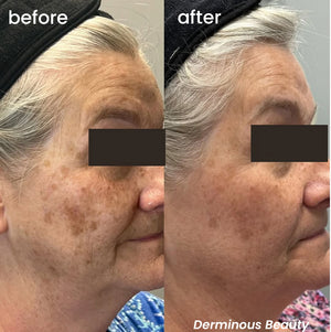 derminous microneedling before and after