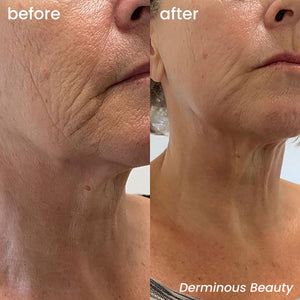 micro infusion at home before and after