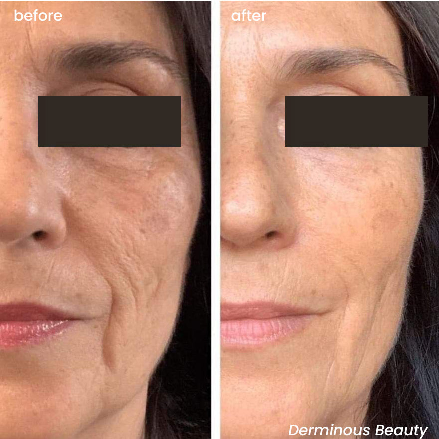 micro infusion before and after